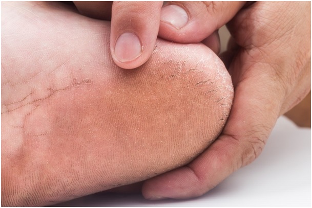 repedt kezelés ujjak cukorbetegség ismeretlen sebek a lábak cukorbetegség kezelésének