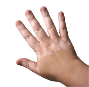 vitiligo1